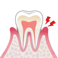 歯肉炎　イメージ