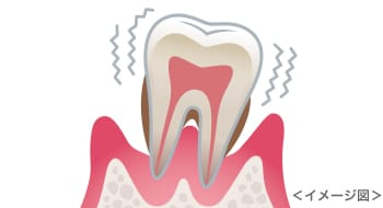 歯周炎　イメージ