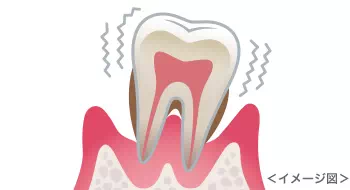 歯周炎　イメージ